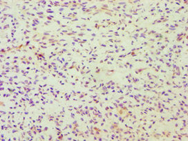 Immunohistochemistry of paraffin-embedded human breast cancer using DDX5 Antibody at dilution of 1:100Rabbit anti-Human DDX5 Polyclonal Antibody