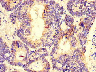 Immunohistochemistry of paraffin-embedded human colon cancer using DDX6 Antibody at dilution of 1:100Rabbit anti-Human DDX6 Polyclonal Antibody