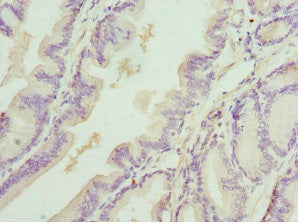 Immunohistochemistry of paraffin-embedded human prostate cancer using DEDD Antibody at dilution of 1:100