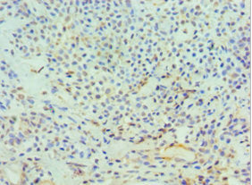 Immunohistochemistry of paraffin-embedded human breast cancer using DFFA Antibody at dilution of 1:100Rabbit anti-Human DFFA Polyclonal Antibody