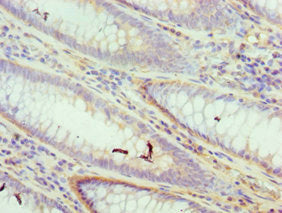 Immunohistochemistry of paraffin-embedded human colon cancer using DFFA Antibody at dilution of 1:100Rabbit anti-Human DFFA Polyclonal Antibody