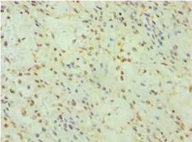 Immunohistochemistry of paraffin-embedded human breast cancer using GSDME Antibody at dilution of 1:100Rabbit anti-Human GSDME Polyclonal Antibody