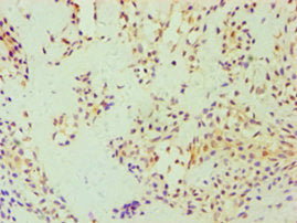 Immunohistochemistry of paraffin-embedded human breast cancer using the antibody at dilution of 1:100Rabbit anti-Human GSDME Polyclonal Antibody