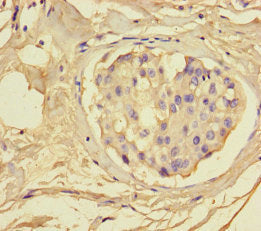 Immunohistochemistry of paraffin-embedded human breast cancer using GSDME Antibody at dilution of 1:100Rabbit anti-Human GSDME Polyclonal Antibody