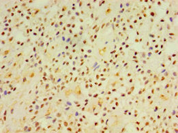 Immunohistochemistry of paraffin-embedded human breast cancer using DGKE Antibody at dilution of 1:100