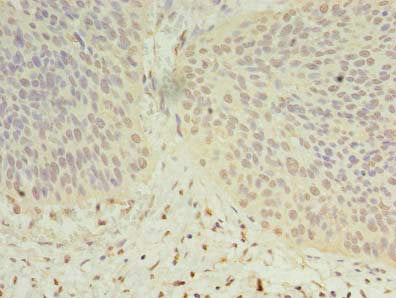 Immunohistochemistry of paraffin-embedded human cervical cancer using DHRS12 Antibody at dilution of 1:100Rabbit anti-Human DHRS12 Polyclonal Antibody