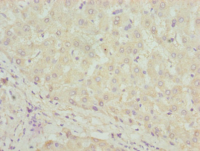 Immunohistochemistry of paraffin-embedded human liver tissue using DHRS3 Antibody at dilution of 1:100Rabbit anti-Human DHRS3 Polyclonal Antibody