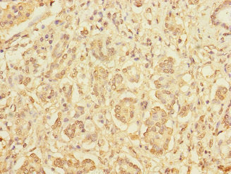 Immunohistochemistry of paraffin-embedded human pancreatic cancer using DIAPH2 Antibody at dilution of 1:100Rabbit anti-Human DIAPH2 Polyclonal Antibody