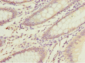 Immunohistochemistry of paraffin-embedded human colon cancer using DNAJA2 Antibody at dilution of 1:100Rabbit anti-Human DNAJA2 Polyclonal Antibody