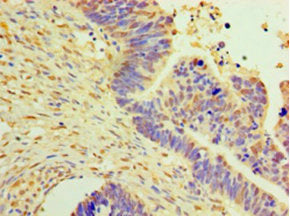 Immunohistochemistry of paraffin-embedded human ovarian cancer using DNAJB2 Antibody at dilution of 1:100Rabbit anti-Human DNAJB2 Polyclonal Antibody