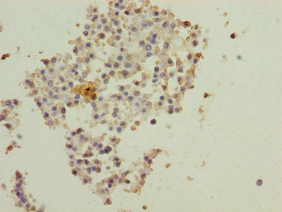 Immunohistochemistry of paraffin-embedded human breast cancer using DNAL4 Antibody at dilution of 1:100Rabbit anti-Human DNAL4 Polyclonal Antibody