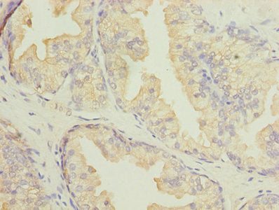 Immunohistochemistry of paraffin-embedded human prostate cancer using DNALI1 Antibody at dilution of 1:100Rabbit anti-Human DNALI1 Polyclonal Antibody