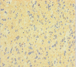 Immunohistochemistry of paraffin-embedded human glioma using the antibody at dilution of 1:100Rabbit anti-Human DNM1 Polyclonal Antibody