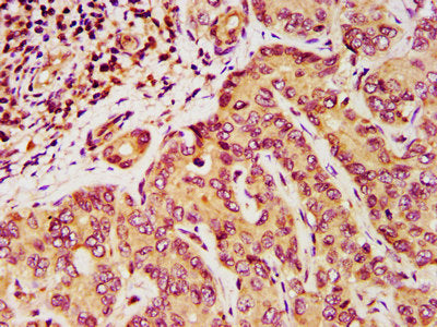 IHC image of DPPA5 Antibody diluted at 1:200 and staining in paraffin-embedded human liver cancer performed on a Leica BondTM system. After dewaxing and hydration, antigen retrieval was mediated by high pressure in a citrate buffer (pH 6.0). Section was blocked with 10% normal goat serum 30min at RT. Then primary antibody (1% BSA) was incubated at 4°C overnight. The primary is detected by a biotinylated secondary antibody and visualized using an HRP conjugated SP system.Rabbit anti-Human DPPA5 Polyclonal Antibody