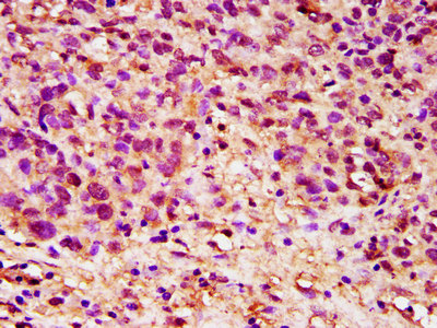 IHC image of DPPA5 Antibody diluted at 1:200 and staining in paraffin-embedded human ovarian cancer performed on a Leica BondTM system. After dewaxing and hydration, antigen retrieval was mediated by high pressure in a citrate buffer (pH 6.0). Section was blocked with 10% normal goat serum 30min at RT. Then primary antibody (1% BSA) was incubated at 4°C overnight. The primary is detected by a biotinylated secondary antibody and visualized using an HRP conjugated SP system.Rabbit anti-Human DPPA5 Polyclonal Antibody