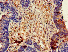 Immunohistochemistry of paraffin-embedded human ovarian cancer using the antibody at dilution of 1:100Rabbit anti-Human DPYSL4 Polyclonal Antibody