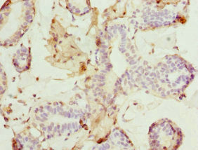 Immunohistochemistry of paraffin-embedded human breast cancer using DR1 Antibody at dilution of 1:100Rabbit anti-Human DR1 Polyclonal Antibody