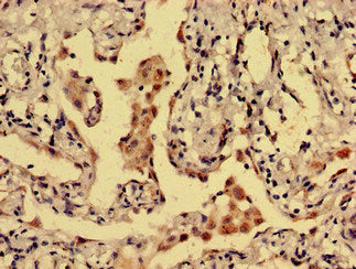 Immunohistochemistry analysis of human lung cancer using DRD1 Antibody at dilution of 1:100Rabbit anti-Human DRD1 Polyclonal Antibody