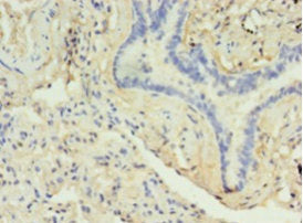 Immunohistochemistry of paraffin-embedded human lung cancer using DRD5 Antibody at dilution of 1:100Rabbit anti-Human DRD5 Polyclonal Antibody