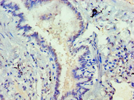 Immunohistochemistry of paraffin-embedded human lung tissue using the antibody at dilution of 1:100Rabbit anti-Human DVL2 Polyclonal Antibody