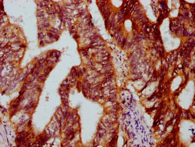 IHC image of DYM Antibody diluted at 1:500 and staining in paraffin-embedded human colon cancer performed on a Leica BondTM system. After dewaxing and hydration, antigen retrieval was mediated by high pressure in a citrate buffer (pH 6.0). Section was blocked with 10% normal goat serum 30min at RT. Then primary antibody (1% BSA) was incubated at 4°C overnight. The primary is detected by a biotinylated secondary antibody and visualized using an HRP conjugated SP system.Rabbit anti-Human DYM Polyclonal Antibody