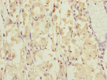 Immunohistochemistry of paraffin-embedded human gastric cancer using DYNC1I1 Antibody at dilution of 1:100Rabbit anti-Human DYNC1I1 Polyclonal Antibody