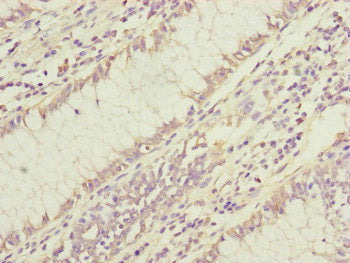 Immunohistochemistry of paraffin-embedded human colon cancer using DYNC1I1 Antibody at dilution of 1:100Rabbit anti-Human DYNC1I1 Polyclonal Antibody