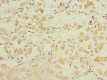 Immunohistochemistry of paraffin-embedded human gastric cancer using DYNC1I1 Antibody at dilution of 1:100Rabbit anti-Human DYNC1I1 Polyclonal Antibody