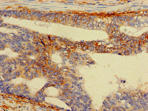 Immunohistochemistry of paraffin-embedded human colon cancer using RPS5 Antibody at dilution of 1:100Rabbit anti-Human RPS5 Polyclonal Antibody