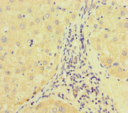 Immunohistochemistry of paraffin-embedded human liver cancer using E2F1 Antibody at dilution of 1:100Rabbit anti-Human E2F1 Polyclonal Antibody