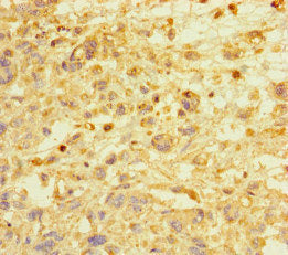 Immunohistochemistry of paraffin-embedded human melanoma using E2F1 Antibody at dilution of 1:100Rabbit anti-Human E2F1 Polyclonal Antibody