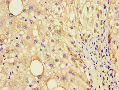 Immunohistochemistry of paraffin-embedded human liver cancer using EBI3 Antibody at dilution of 1:100Rabbit anti-Human EBI3 Polyclonal Antibody