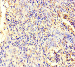 Immunohistochemistry of paraffin-embedded human cervical cancer using ECEL1 Antibody at dilution of 1:100