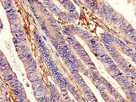 Immunohistochemistry of paraffin-embedded human colon cancer using EEA1 Antibody at dilution of 1:100Rabbit anti-Human EEA1 Polyclonal Antibody