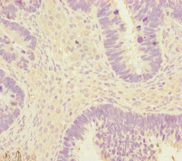 Immunohistochemistry of paraffin-embedded human ovarian cancer using EEF1A2 Antibody at dilution of 1:100Rabbit anti-Human EEF1A2 Polyclonal Antibody