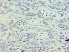 Immunohistochemistry of paraffin-embedded human breast cancer using EEF1E1 Antibody at dilution of 1:100
