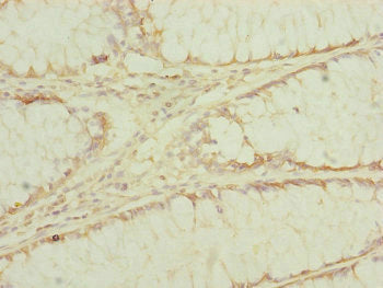 Immunohistochemistry of paraffin-embedded human colon cancer using EEF1G Antibody at dilution of 1:100Rabbit anti-Human EEF1G Polyclonal Antibody