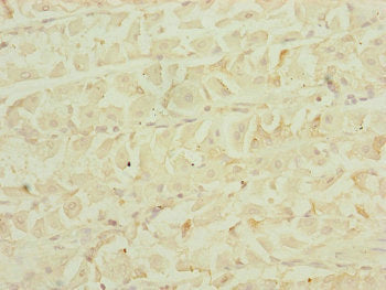 Immunohistochemistry of paraffin-embedded human gastric cancer using EEF1G Antibody at dilution of 1:100Rabbit anti-Human EEF1G Polyclonal Antibody