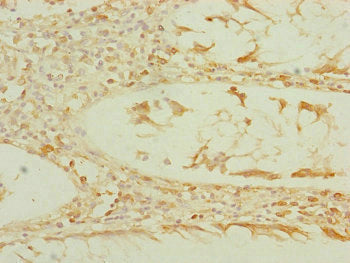 Immunohistochemistry of paraffin-embedded human colon cancer using EEF1G Antibody at dilution of 1:100Rabbit anti-Human EEF1G Polyclonal Antibody