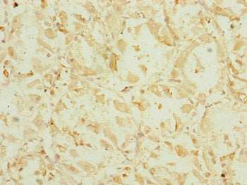 Immunohistochemistry of paraffin-embedded human gastric cancer using EEF1G Antibody at dilution of 1:100Rabbit anti-Human EEF1G Polyclonal Antibody