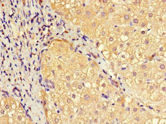 Immunohistochemistry of paraffin-embedded human liver cancer using EFCAB7 Antibody at dilution of 1:100Rabbit anti-Human EFCAB7 Polyclonal Antibody