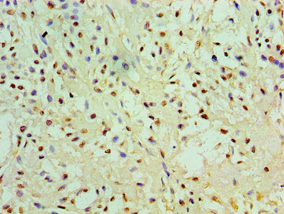 Immunohistochemistry of paraffin-embedded human breast cancer using EGLN2 Antibody at dilution of 1:100Rabbit anti-Human EGLN2 Polyclonal Antibody