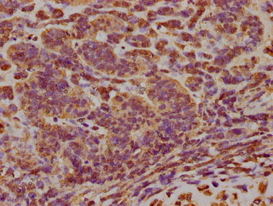 IHC image of the antibody diluted at 1:300 and staining in paraffin-embedded human ovarian cancer performed on a Leica BondTM system. After dewaxing and hydration, antigen retrieval was mediated by high pressure in a citrate buffer (pH 6.0). Section was blocked with 10% normal goat serum 30min at RT. Then primary antibody (1% BSA) was incubated at 4°C overnight. The primary is detected by a biotinylated secondary antibody and visualized using an HRP conjugated SP system.Rabbit anti-Human EIF2AK3 Polyclonal Antibody