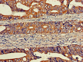 Immunohistochemistry of paraffin-embedded human colon cancer using the antibody at dilution of 1:100