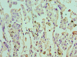 Immunohistochemistry of paraffin-embedded human lung cancer using EIF4A1 Antibody at dilution of 1:100Rabbit anti-Human EIF4A1 Polyclonal Antibody