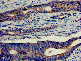 Immunohistochemistry of paraffin-embedded human colon cancer using the antibody at dilution of 1:100Rabbit anti-Human EIF4B Polyclonal Antibody