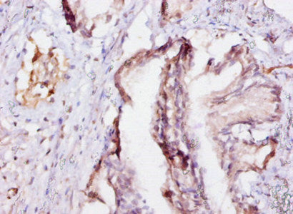 Immunohistochemistry of paraffin-embedded human prostate tissue using EIF4EBP2 Antibody at dilution of 1:10Rabbit anti-Human EIF4EBP2 Polyclonal Antibody