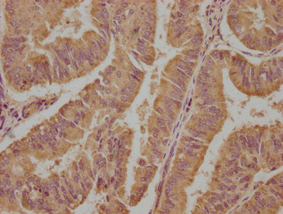 IHC image of EIF4G2 Antibody diluted at 1:100 and staining in paraffin-embedded human endometrial cancer performed on a Leica BondTM system. After dewaxing and hydration, antigen retrieval was mediated by high pressure in a citrate buffer (pH 6.0). Section was blocked with 10% normal goat serum 30min at RT. Then primary antibody (1% BSA) was incubated at 4°C overnight. The primary is detected by a biotinylated secondary antibody and visualized using an HRP conjugated SP system.Rabbit anti-Human EIF4G2 Polyclonal Antibody