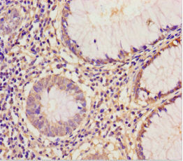 Immunohistochemistry of paraffin-embedded human colon cancer using the antibody at dilution of 1:100Rabbit anti-Human EIF6 Polyclonal Antibody