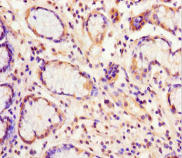 Immunohistochemistry of paraffin-embedded human gastric cancer using EIF6 Antibody at dilution of 1:100Rabbit anti-Human EIF6 Polyclonal Antibody